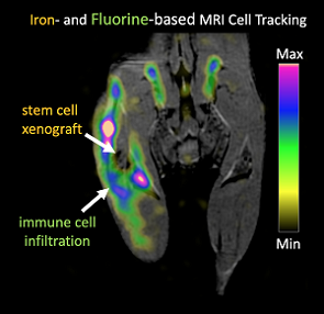 Iron- and fluorine-based MRI cell tracking shows the immune response to a stem cell transplant.